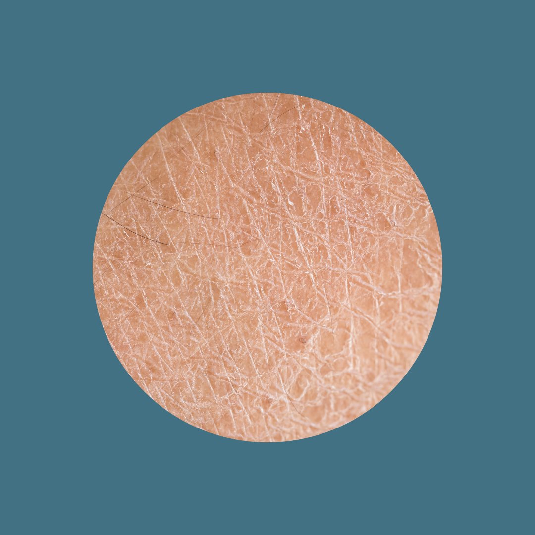 Dry Skin