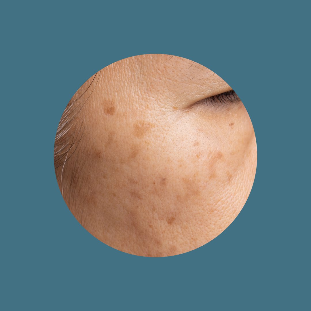 Hyperpigmentation