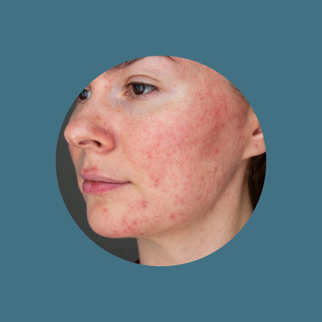 Sensitive, Rosacea, Redness