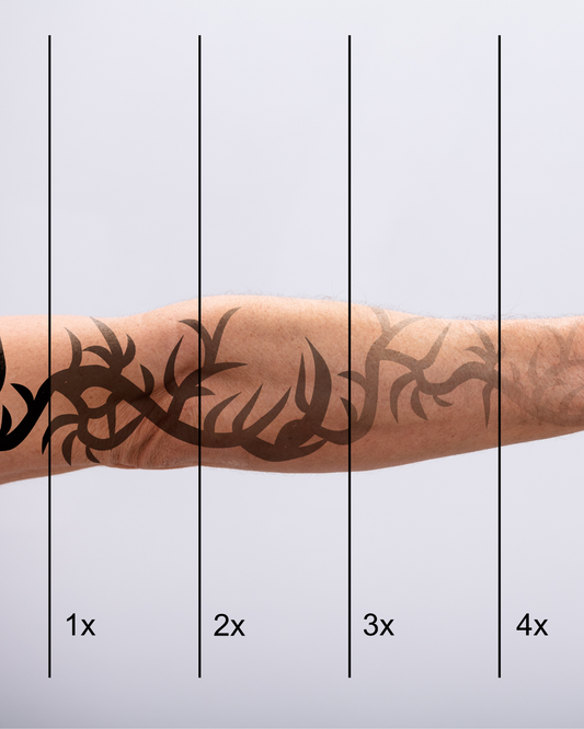 Picosure Tattoo Removal