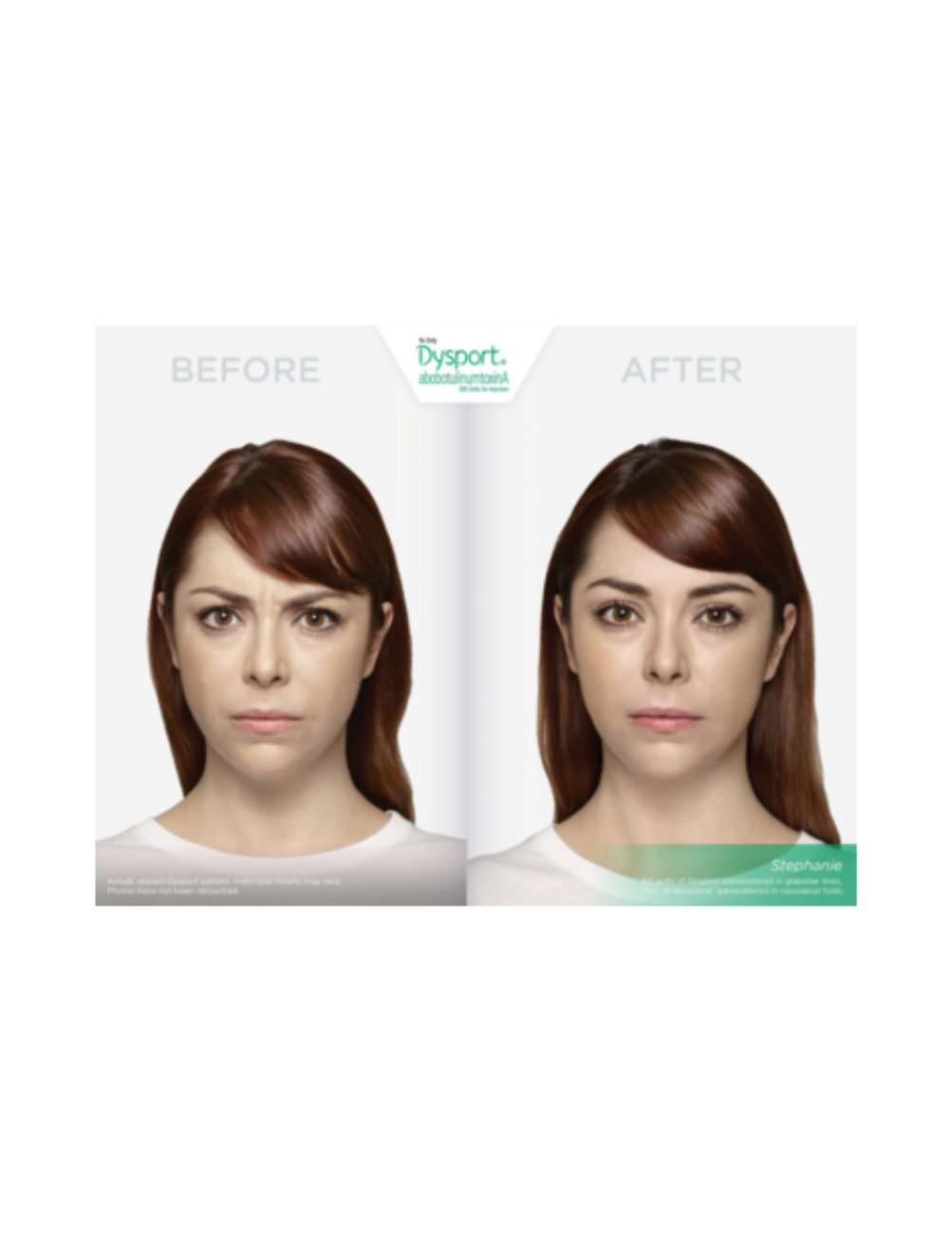 Botox, Dysport or Daxxify