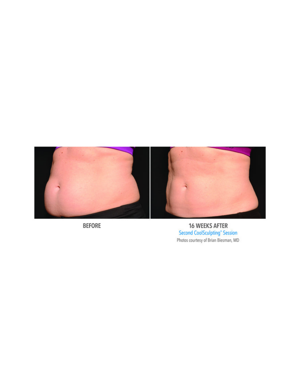 CoolSculpting Elite Fat Reduction