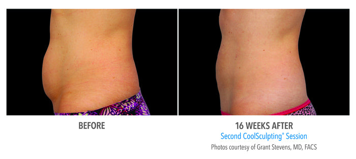 CoolSculpting Elite Fat Reduction