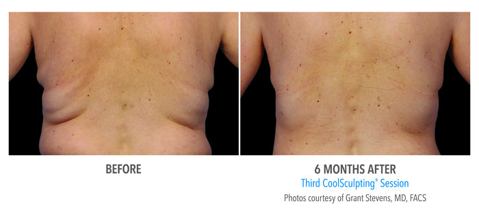 CoolSculpting Elite Fat Reduction