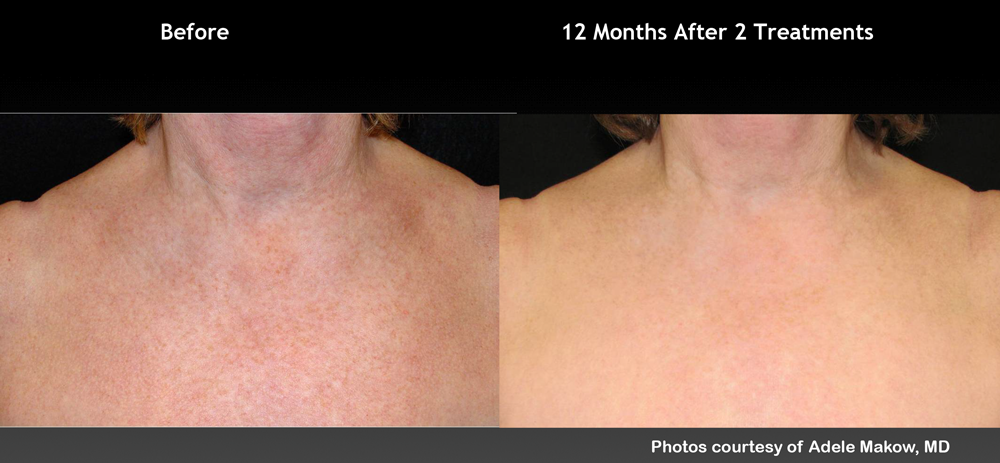 IPL Photofacial