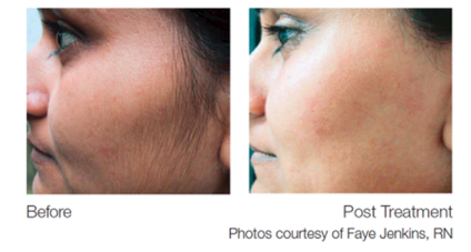 Laser Hair Removal Packages