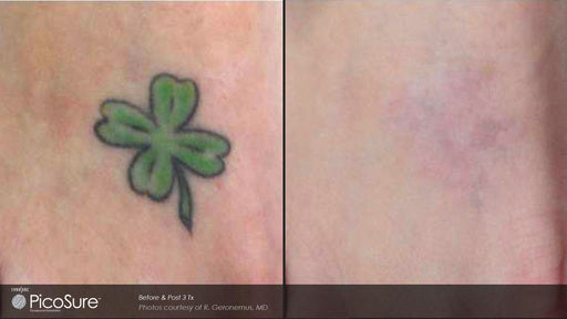 Picosure Tattoo Removal
