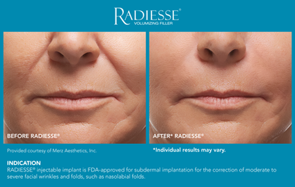 Radiesse- Dermal filler