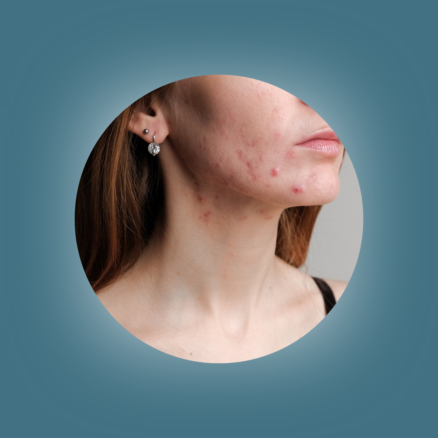 Acne products