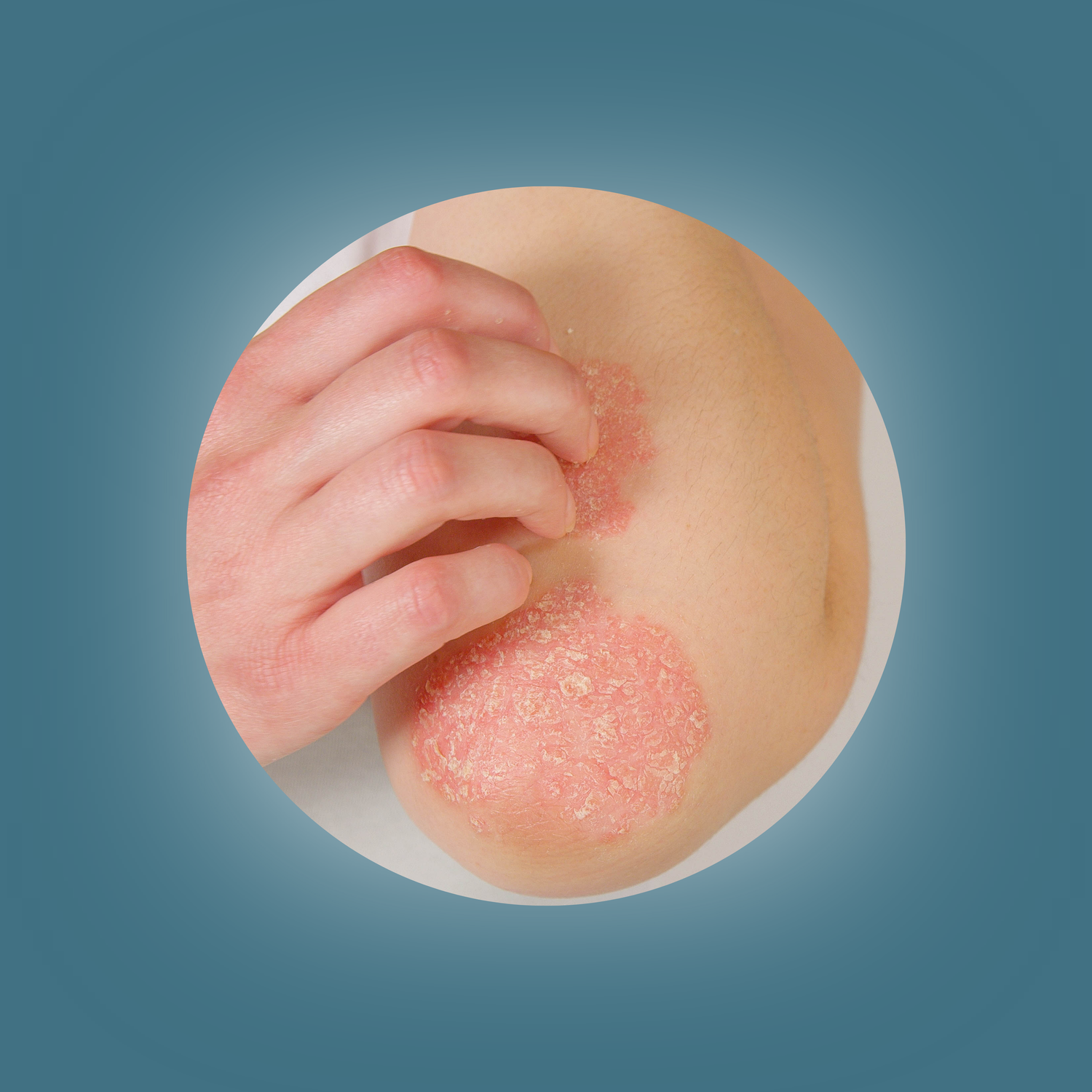 Eczema/ Psoriasis Relief