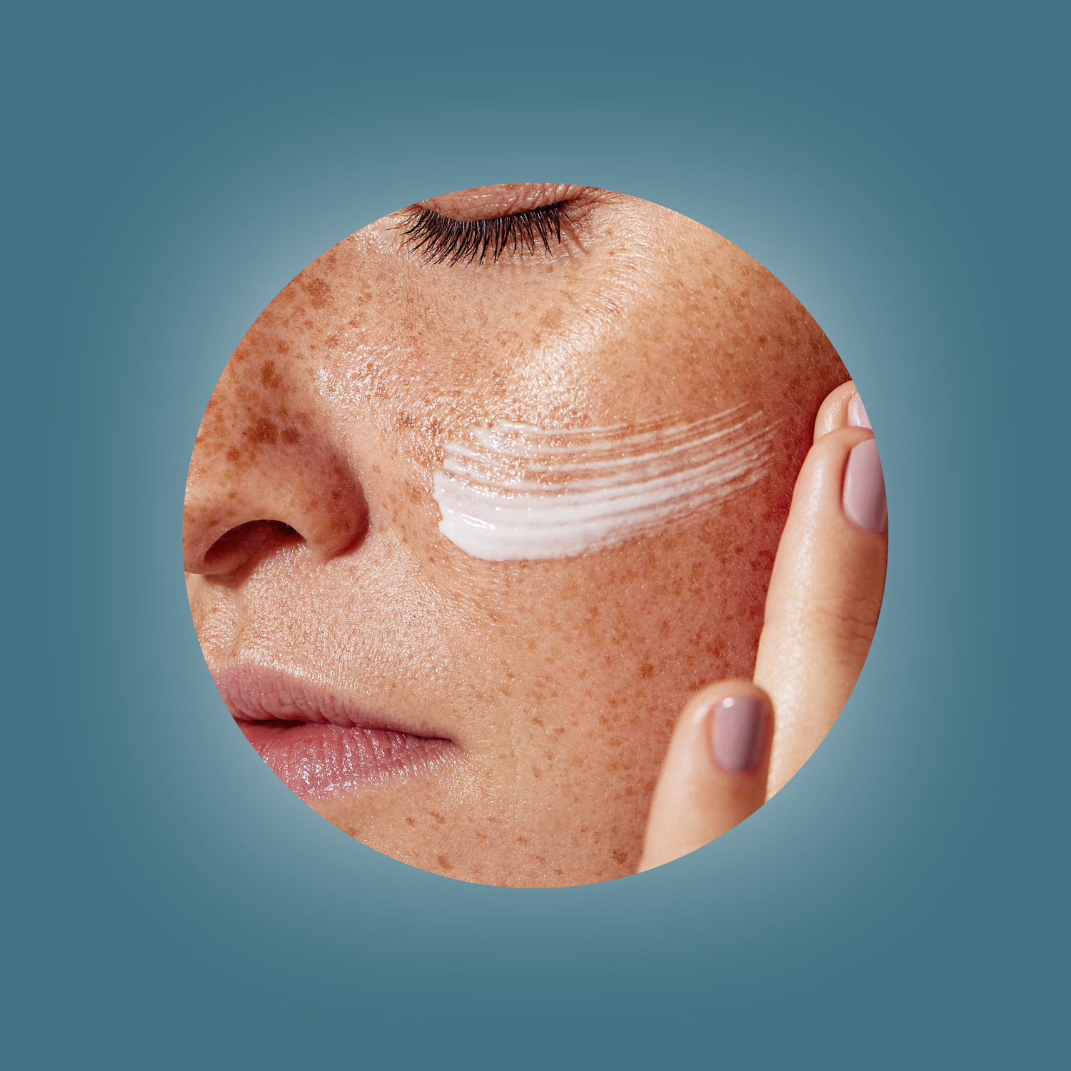 Hyperpigmentation