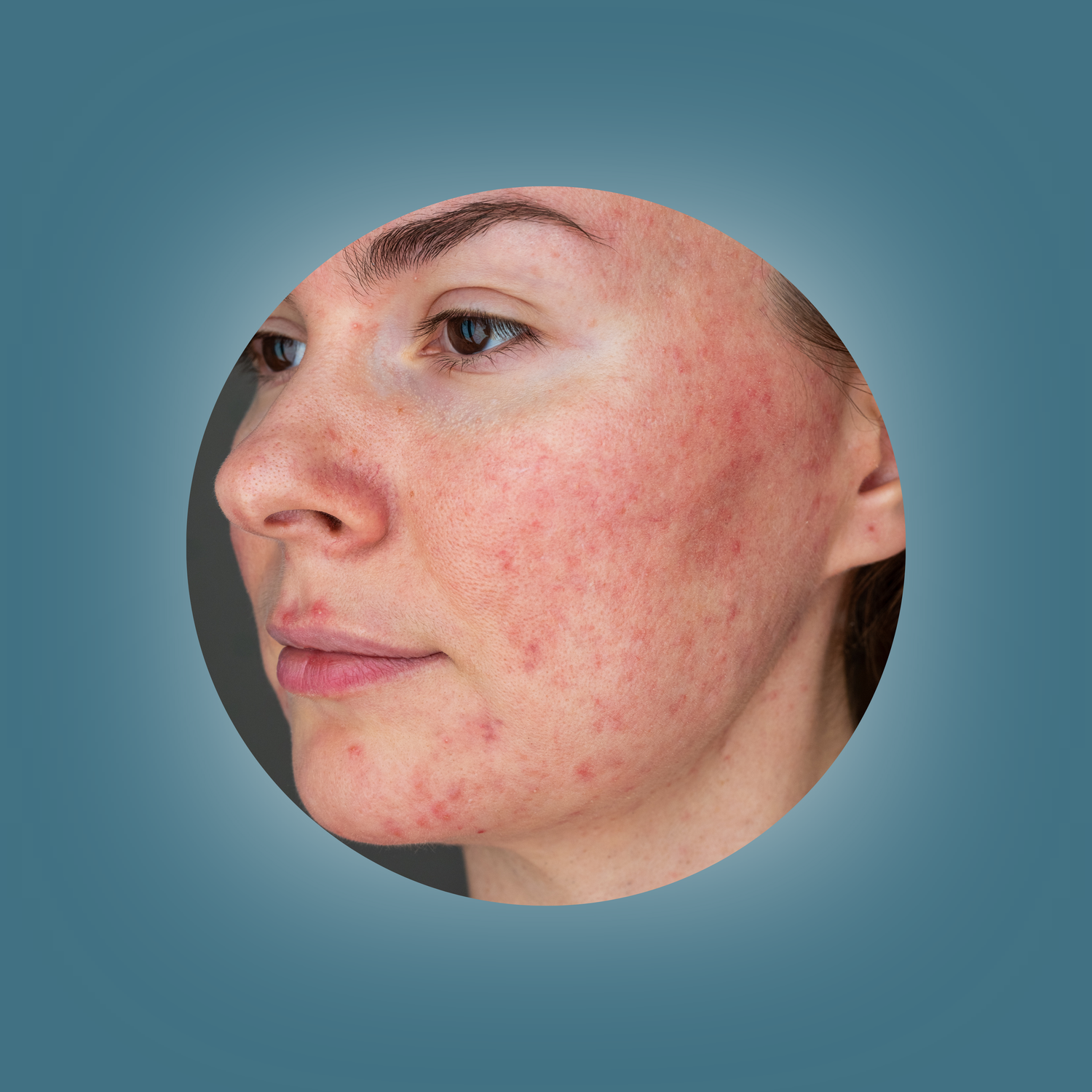 Sensitive, Rosacea, Redness