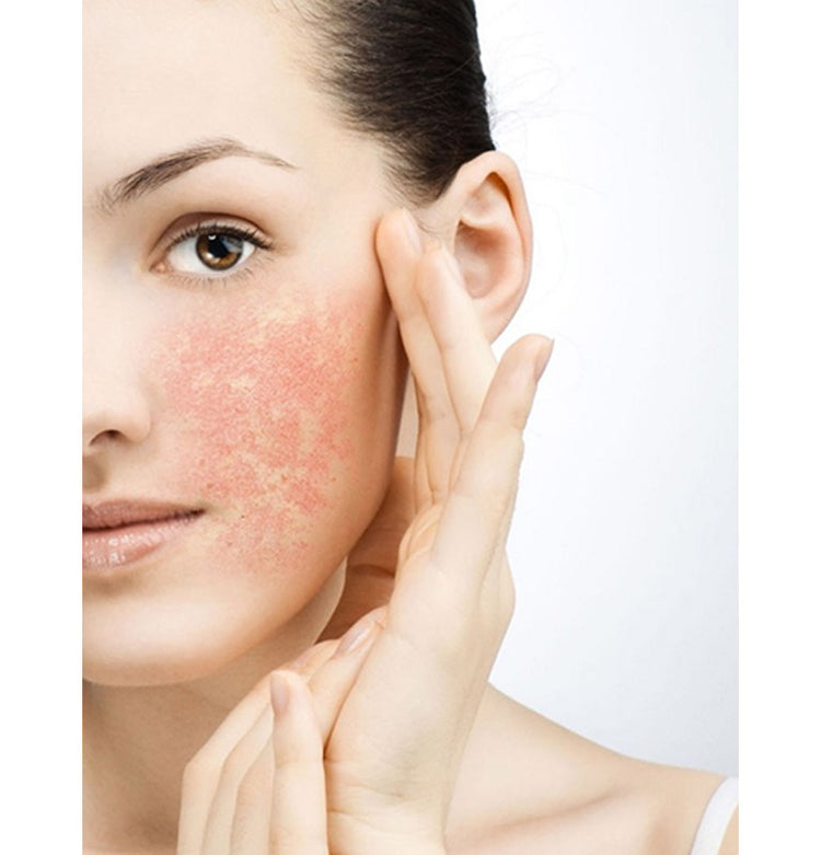 Sensitive & redness prone skin
