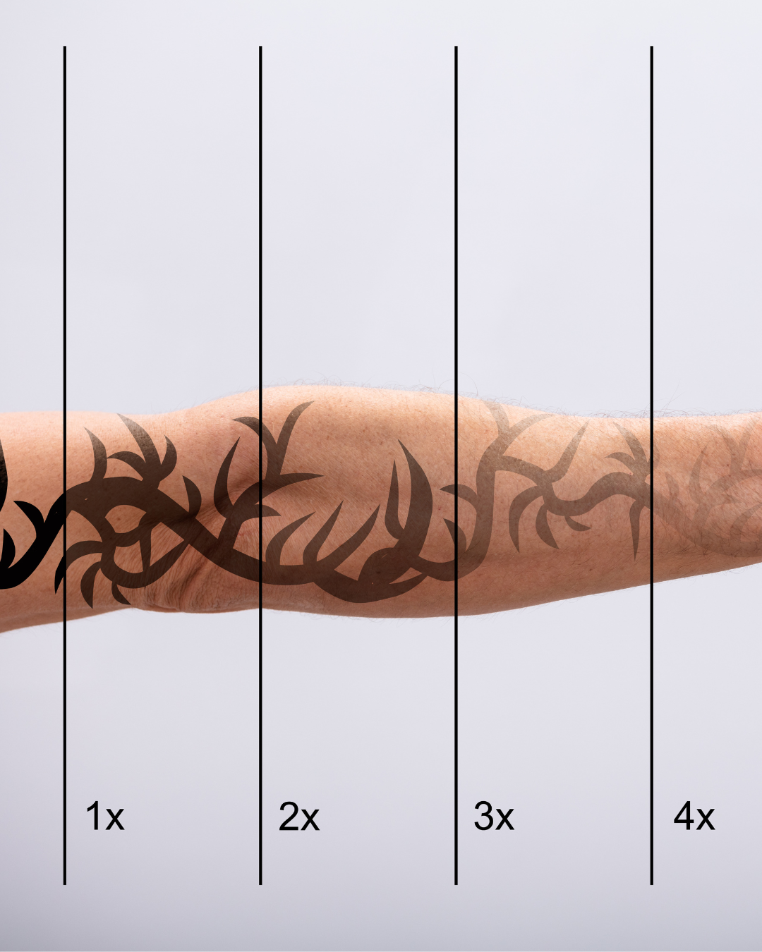 Picosure Tattoo Removal – Cascade Eye & Skin Centers