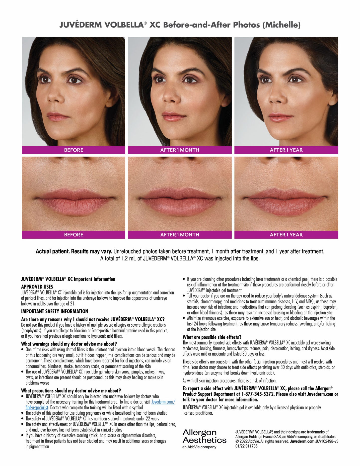 Juvéderm collection of dermal fillers