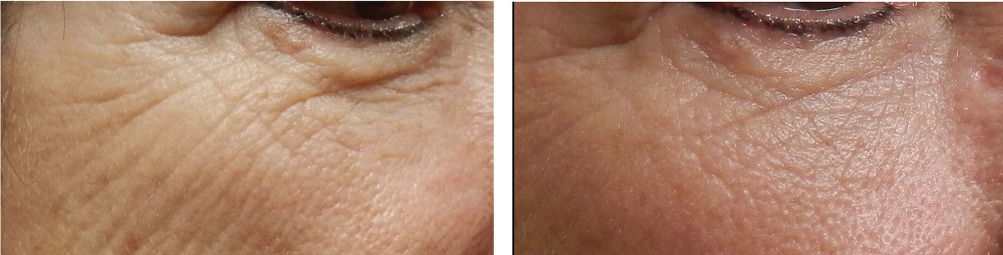 Microneedling