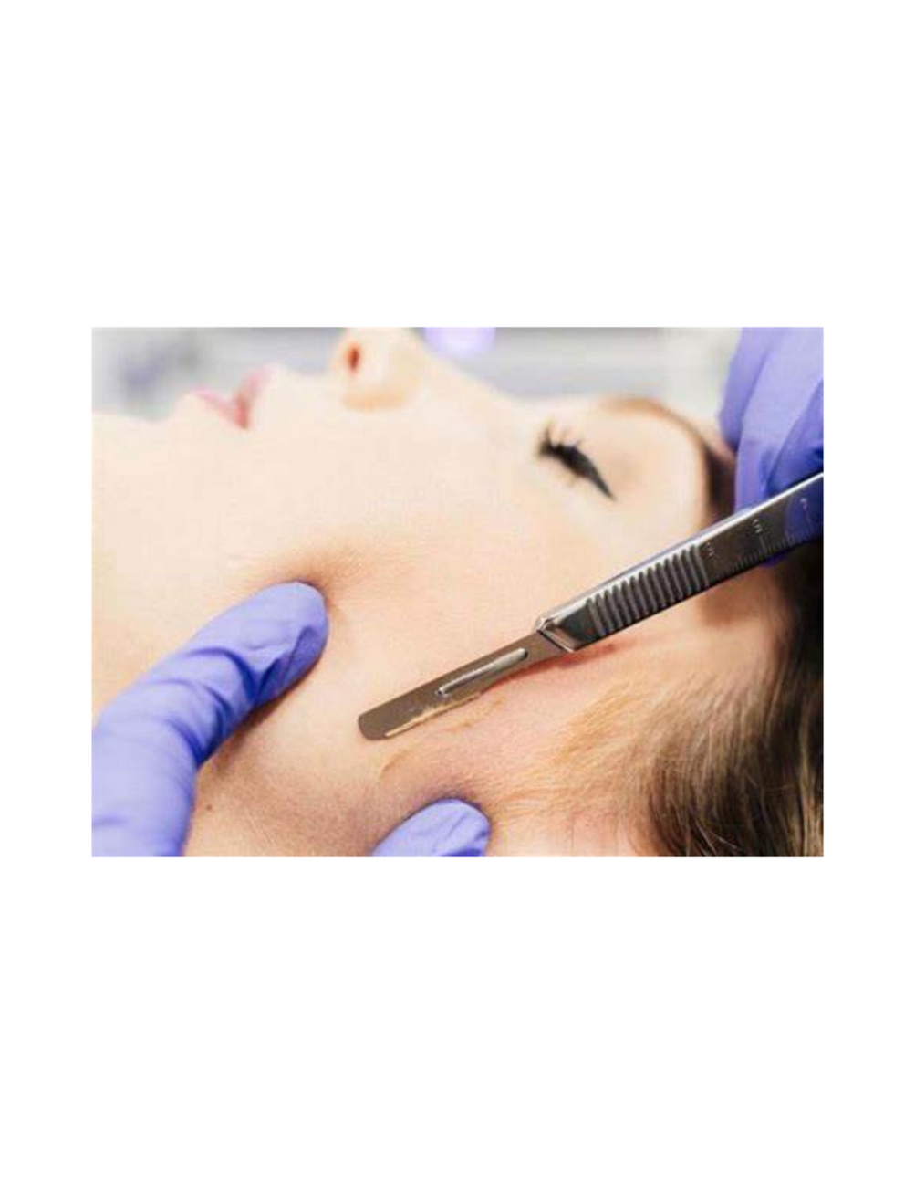 Dermaplaning