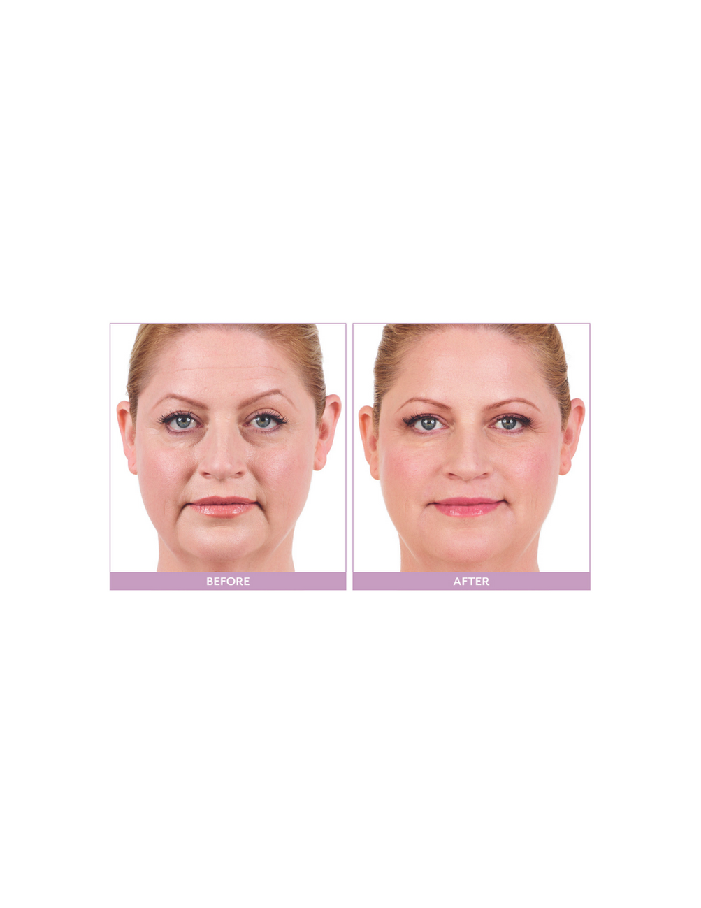 Juvéderm collection of dermal fillers