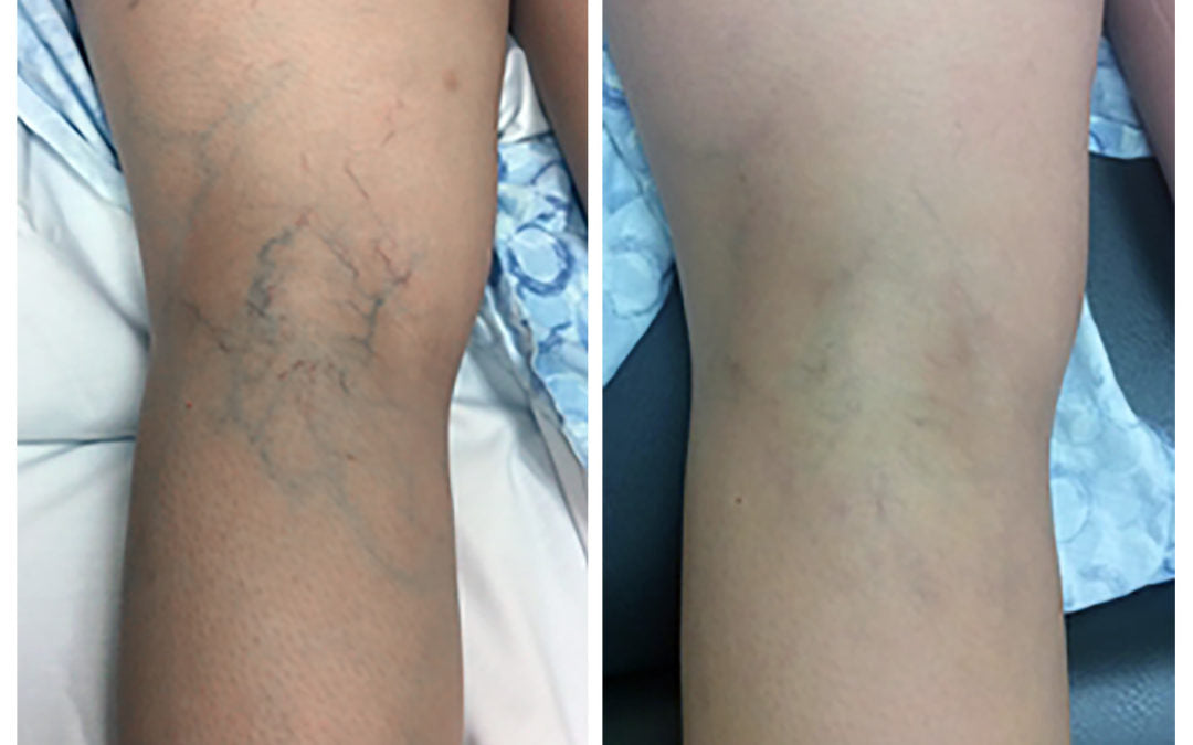 Sclerotherapy- spider vein reduction