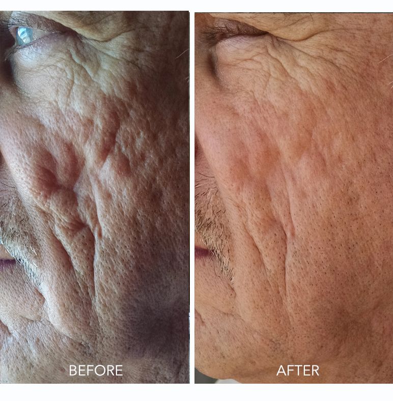 Microneedling