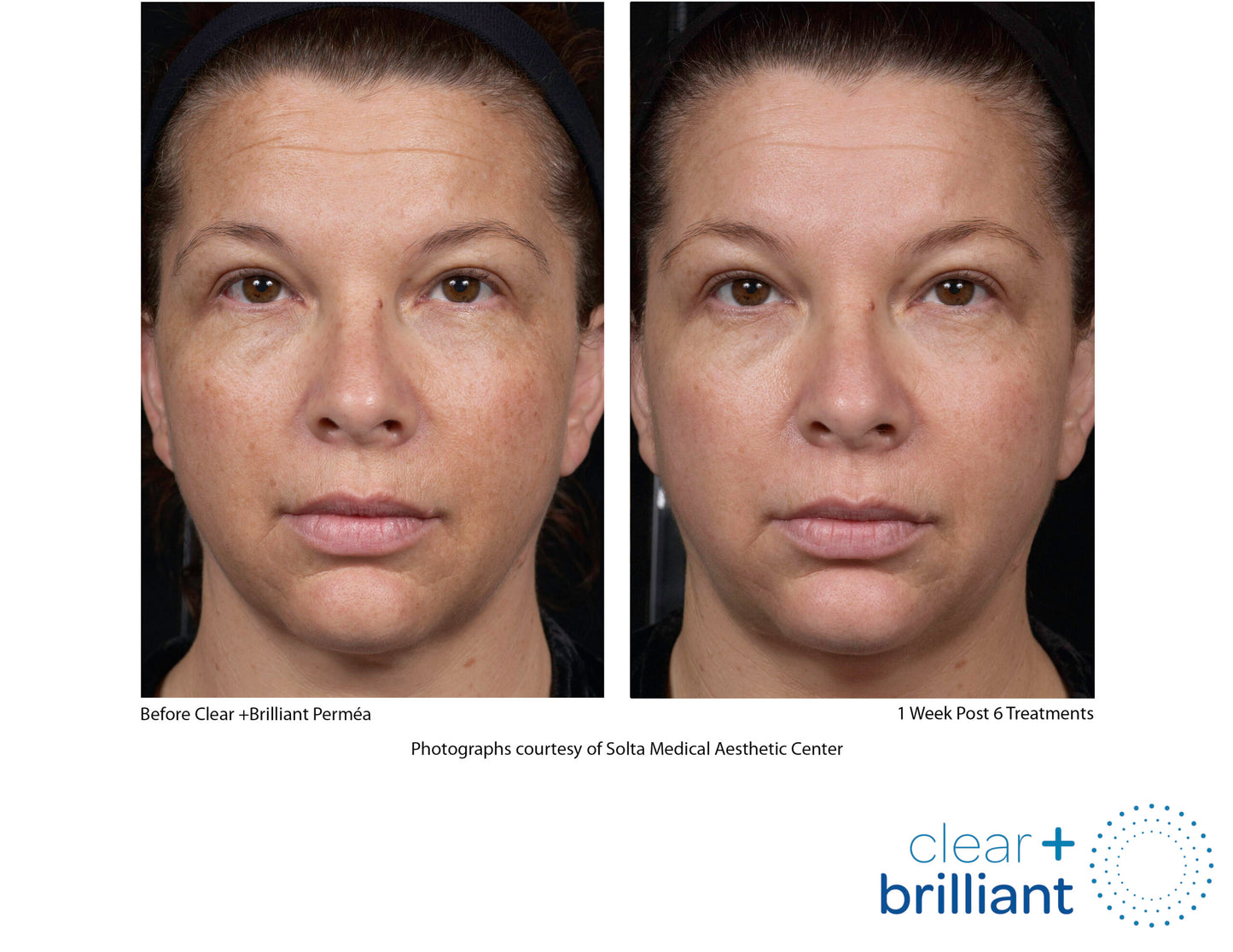 Clear & Brilliant Laser – Cascade Eye & Skin Centers