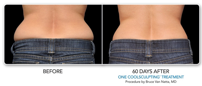 Hip fat removal without surgery with CoolSculpting