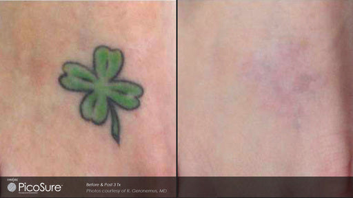 My tattoo removal progress with PicoSure laser : r/TattooRemoval