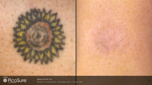 Picosure Tattoo Removal