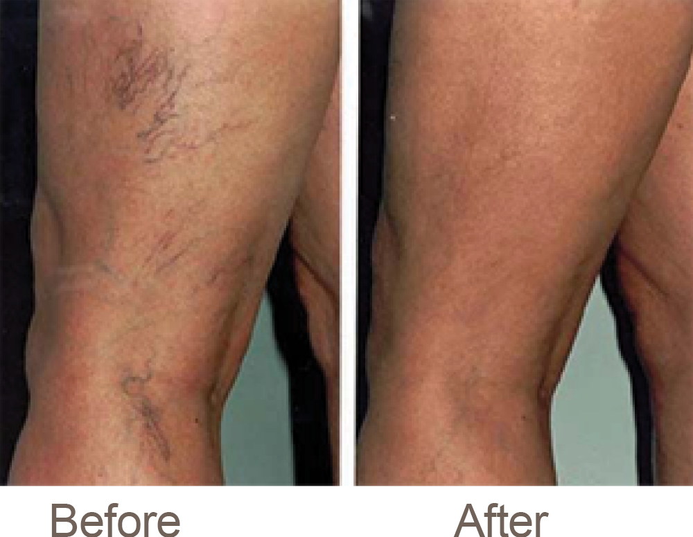 Sclerotherapy- spider vein reduction