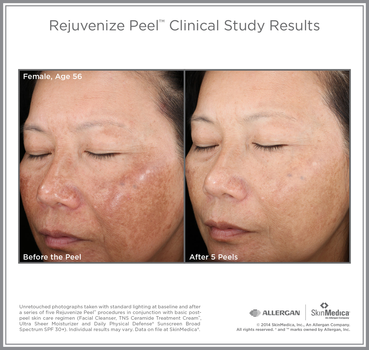 Chemical Peels